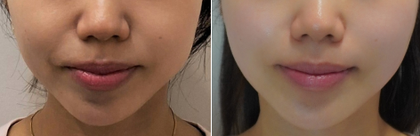 티타늄60KJ 전후사진