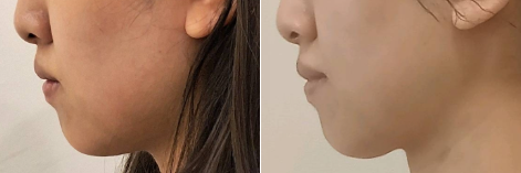 온다6만줄+턱끝필러1cc 전후사진