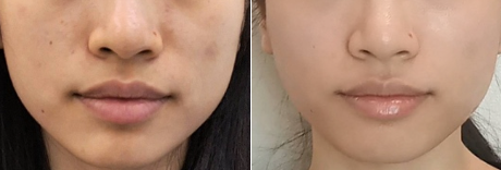 포텐자 전후사진