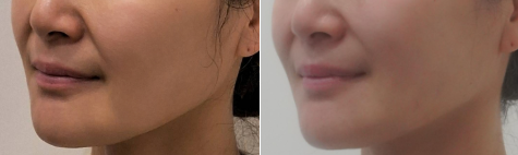 울써마지/울쎄라300+써마지300 전후사진