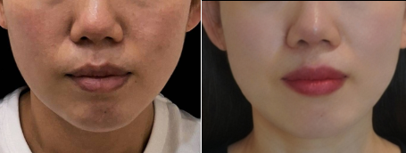 포텐자+쥬베룩4CC 전후사진