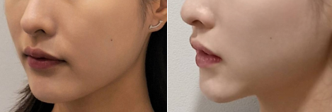 티타늄60KJ 전후사진