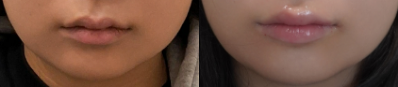 입술필러 레스틸렌1cc