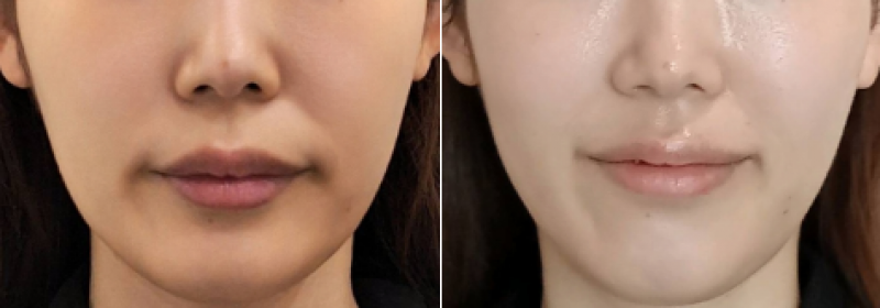온다+티타늄