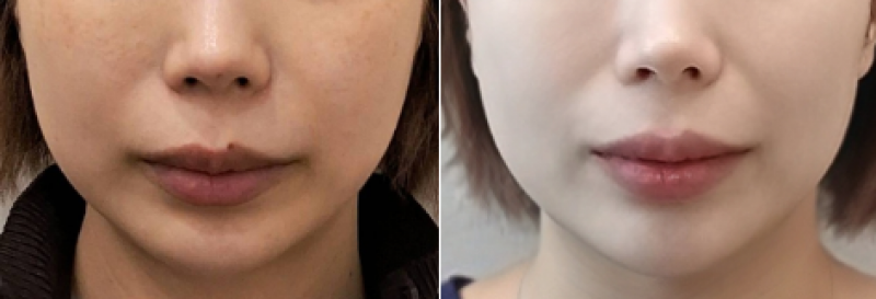 듀얼토닝