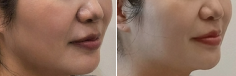 울쎄라프라임600샷