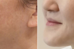  울쎄라프라임600샷 전후사진